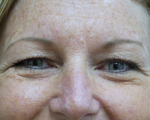 Blepharoplasty Before and After Pictures Fort Lauderdale, FL