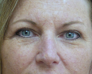 Blepharoplasty Before and After Pictures Fort Lauderdale, FL