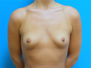 Breast Augmentation Before and After Pictures Fort Lauderdale, FL