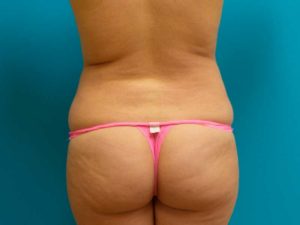 Brazilian Butt Lift Before and After Pictures Fort Lauderdale, FL