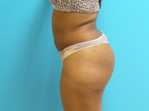 Brazilian Butt Lift Before and After Pictures Fort Lauderdale, FL