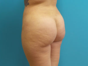 Brazilian Butt Lift Before and After Pictures Fort Lauderdale, FL