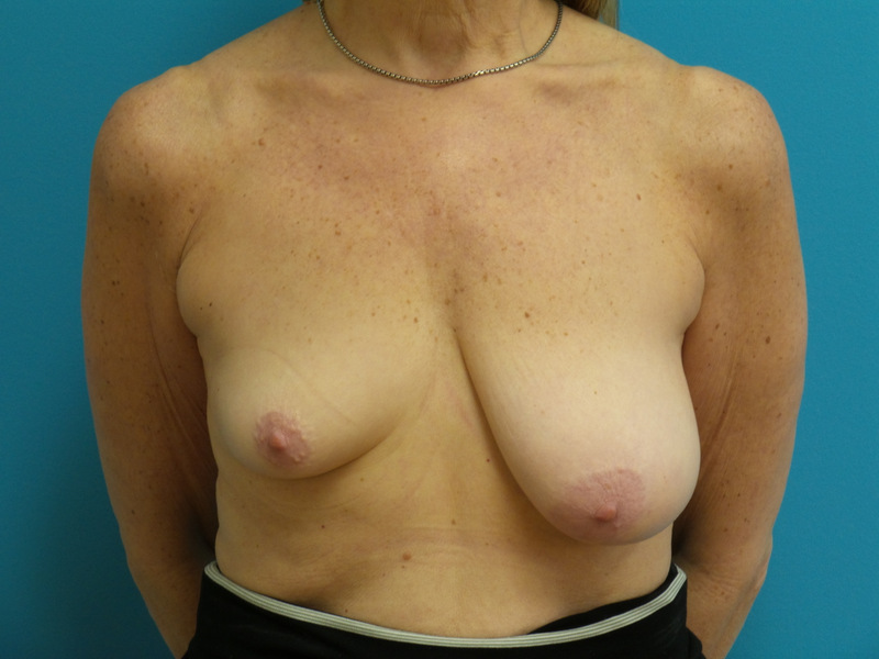 Breast Lift with Augmentation Before and After Pictures Fort Lauderdale, FL