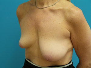 Breast Lift with Augmentation Before and After Pictures Fort Lauderdale, FL