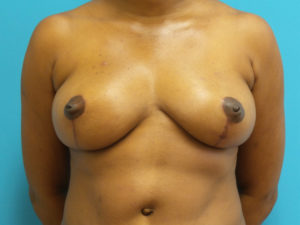 Breast Reduction Before and After Pictures Fort Lauderdale, FL