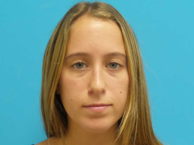 6464006 Chin Augmentation Before and After Pictures Fort Lauderdale, FL