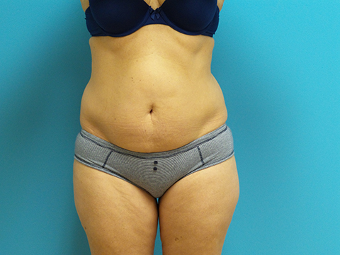 Liposuction Before and After Pictures Fort Lauderdale, FL