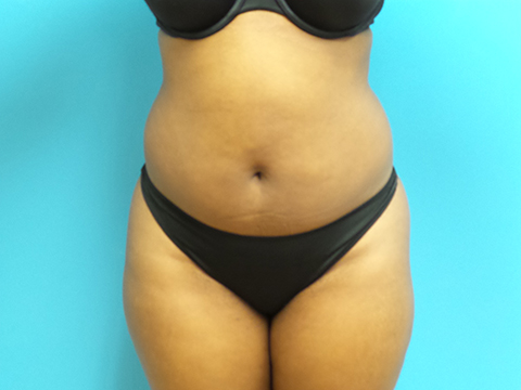 Liposuction Before and After Pictures Fort Lauderdale, FL