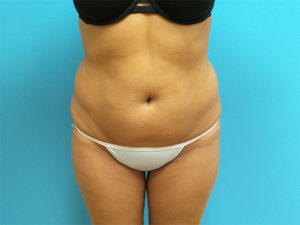 Liposuction Before and After Pictures Fort Lauderdale, FL