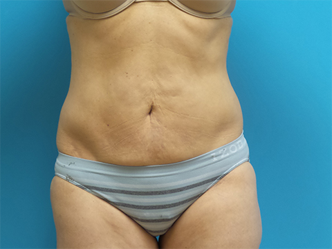 Liposuction Before and After Pictures Fort Lauderdale, FL