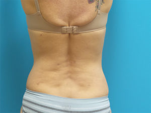 Liposuction Before and After Pictures Fort Lauderdale, FL