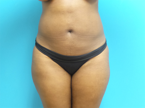 Liposuction Before and After Pictures Fort Lauderdale, FL