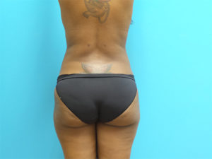 Liposuction Before and After Pictures Fort Lauderdale, FL