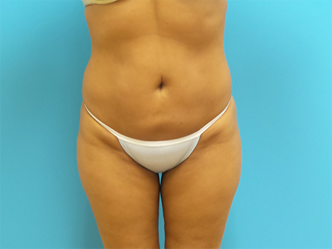 Liposuction Before and After Pictures Fort Lauderdale, FL