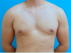 Gynecomastia Before and After Pictures Fort Lauderdale, FL