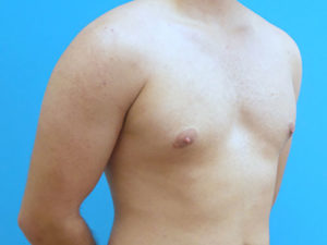 Gynecomastia Before and After Pictures Fort Lauderdale, FL