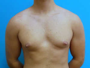 Gynecomastia Before and After Pictures Fort Lauderdale, FL