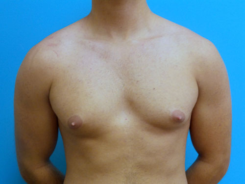 Gynecomastia Before and After Pictures Fort Lauderdale, FL