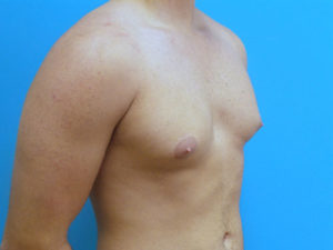 Gynecomastia Before and After Pictures Fort Lauderdale, FL