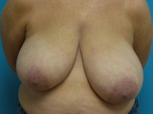 Breast Reduction Before and After Pictures Fort Lauderdale, FL