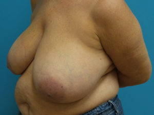Breast Reduction Before and After Pictures Fort Lauderdale, FL