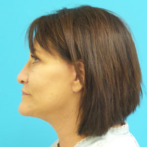 Facelift Before and After Pictures Fort Lauderdale, FL