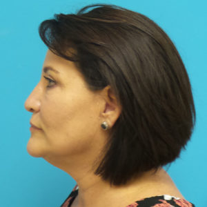 Facelift Before and After Pictures Fort Lauderdale, FL