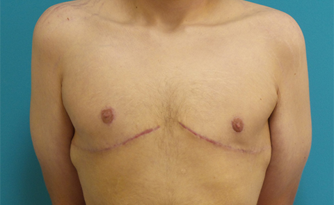 Gynecomastia Before and After Pictures Fort Lauderdale, FL