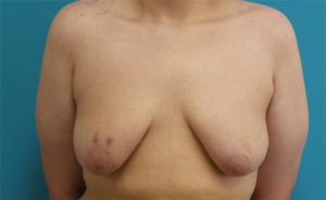 Gynecomastia Before and After Pictures Fort Lauderdale, FL