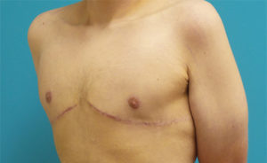 Gynecomastia Before and After Pictures Fort Lauderdale, FL