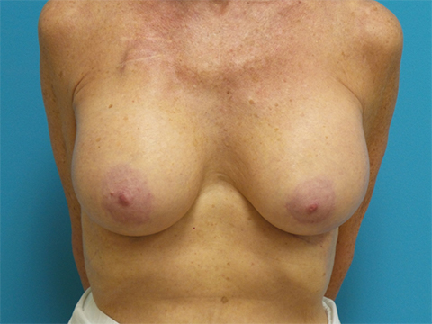 Breast Implant Revision/Replacement Before and After Pictures Fort Lauderdale, FL