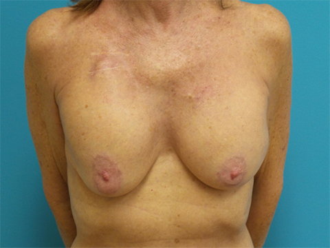 Breast Implant Revision/Replacement Before and After Pictures Fort Lauderdale, FL