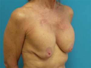 Breast Implant Revision/Replacement Before and After Pictures Fort Lauderdale, FL