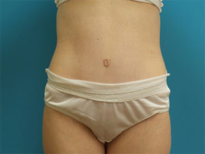 Tummy Tuck Before and After Pictures Fort Lauderdale, FL