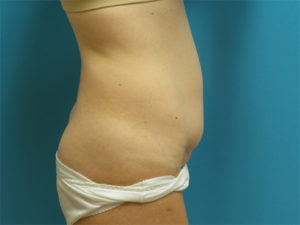 Tummy Tuck Before and After Pictures Fort Lauderdale, FL