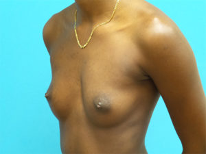 Breast Augmentation Before and After Pictures Fort Lauderdale, FL