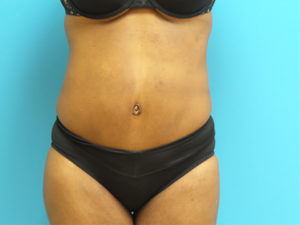 Extended Abdominoplasty Before and After Pictures Fort Lauderdale, FL