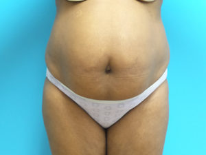 Extended Abdominoplasty Before and After Pictures Fort Lauderdale, FL