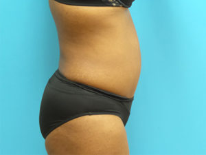 Extended Abdominoplasty Before and After Pictures Fort Lauderdale, FL