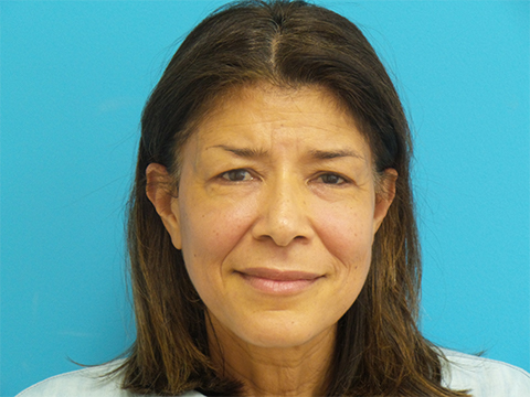EyelidSurgery-case15-front-after Blepharoplasty Before and After Pictures Fort Lauderdale, FL