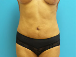 Liposuction Before and After Pictures Fort Lauderdale, FL