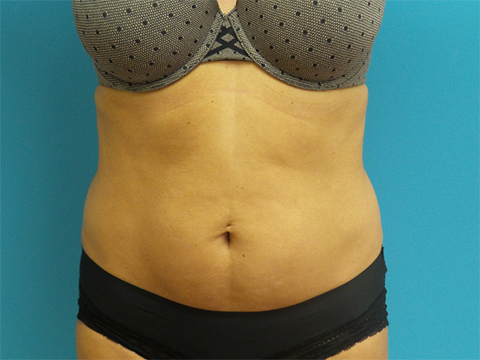 Liposuction-case19-front-before Liposuction Before and After Pictures Fort Lauderdale, FL