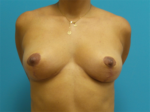 breast-lift-case9-front-after Breast Lift Before and After Pictures Fort Lauderdale, FL