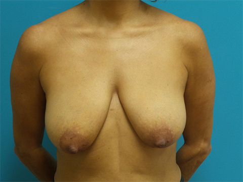 breast-lift-case9-front-before Breast Lift Before and After Pictures Fort Lauderdale, FL