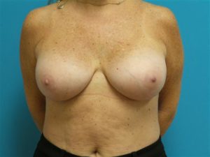 Breast Implant Revision/Replacement Before and After Pictures Fort Lauderdale, FL