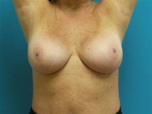 Breast Implant Revision/Replacement Before and After Pictures Fort Lauderdale, FL