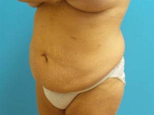 Extended Abdominoplasty Before and After Pictures Fort Lauderdale, FL