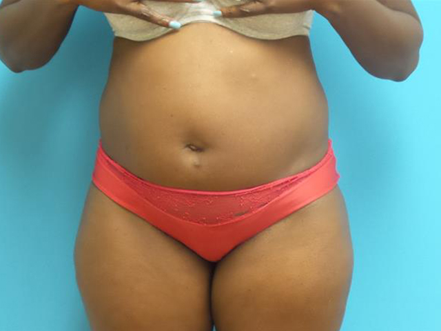 Liposuction Before and After Pictures Fort Lauderdale, FL