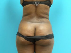 Liposuction Before and After Pictures Fort Lauderdale, FL