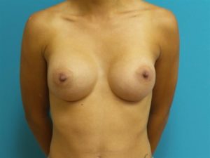 Breast Augmentation Before and After Pictures Fort Lauderdale, FL